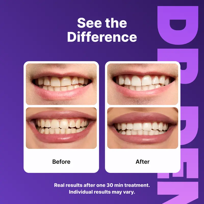 DR DENT Purple Teeth Whitening Strips - Gentle & Effective - Image 4